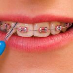 benefits of interdental cleaning